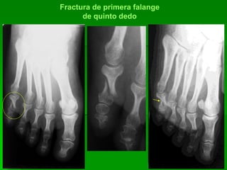 Fractura de primera falange
de quinto dedo
 