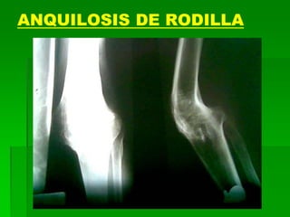 ANQUILOSIS DE RODILLA
 