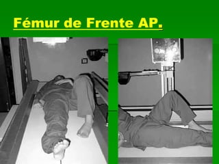 Fémur de Frente AP.
 