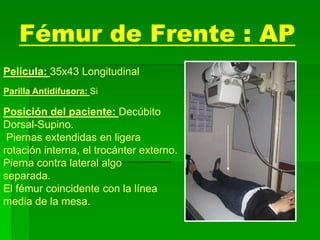 Fémur de Frente : AP
Película: 35x43 Longitudinal
Parilla Antidifusora: Si
Posición del paciente: Decúbito
Dorsal-Supino.
Piernas extendidas en ligera
rotación interna, el trocánter externo.
Pierna contra lateral algo
separada.
El fémur coincidente con la línea
media de la mesa.
 