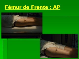 Fémur de Frente : AP
 