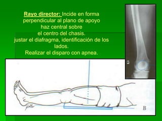 Rayo director: Incide en forma
perpendicular al plano de apoyo
haz central sobre
el centro del chasis.
justar el diafragma, identificación de los
lados.
Realizar el disparo con apnea.
 