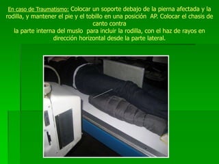 En caso de Traumatismo: Colocar un soporte debajo de la pierna afectada y la
rodilla, y mantener el pie y el tobillo en una posición AP. Colocar el chasis de
canto contra
la parte interna del muslo para incluir la rodilla, con el haz de rayos en
dirección horizontal desde la parte lateral.
 