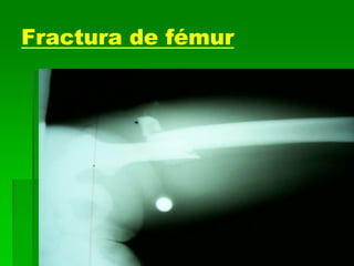 Fractura de fémur
 