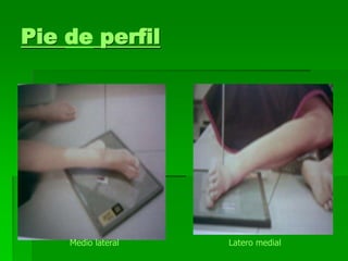 Pie de perfil
Latero medialMedio lateral
 