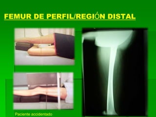 FEMUR DE PERFIL/REGIÓN DISTAL
Paciente accidentado
 