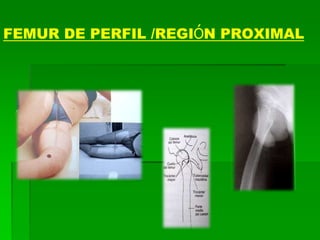 FEMUR DE PERFIL /REGIÓN PROXIMAL
 