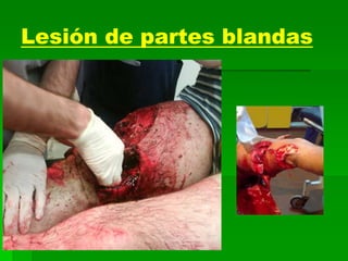 Lesión de partes blandas
 