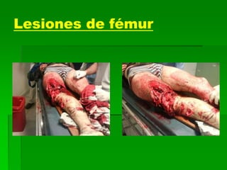 Lesiones de fémur
 