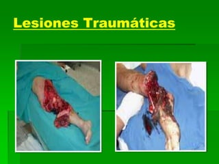 Lesiones Traumáticas
 