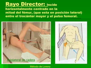 Rayo Director: Incide
horizontalmente centrado en la
mitad del fémur, (que esta en posición lateral)
entre el trocánter mayor y el pulso femoral.
Axiolateral de cadera
Método de Lorenz
 