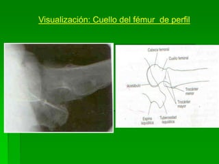Visualización: Cuello del fémur de perfil
 