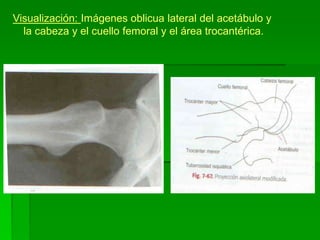 Visualización: Imágenes oblicua lateral del acetábulo y
la cabeza y el cuello femoral y el área trocantérica.
 