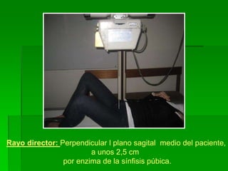 Rayo director: Perpendicular l plano sagital medio del paciente,
a unos 2,5 cm
por enzima de la sínfisis púbica.
 