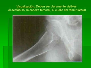 Visualización: Deben ser claramente visibles:
el acetábulo, la cabeza femoral, el cuello del fémur lateral.
 