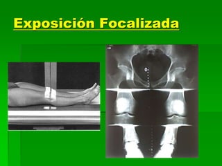 Exposición Focalizada
 