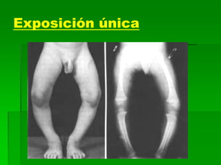 Exposición única
 