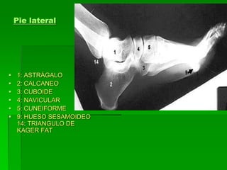Pie lateral
 1: ASTRÁGALO
 2: CALCANEO
 3: CUBOIDE
 4: NAVICULAR
 5: CUNEIFORME
 9: HUESO SESAMOIDEO
14: TRIANGULO DE
KAGER FAT
 