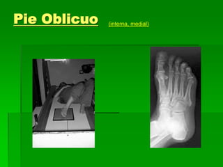 Pie Oblicuo (interna, medial)
 