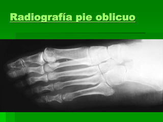 Radiografía pie oblicuo
 