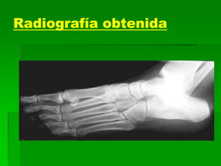 Radiografía obtenida
 