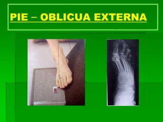 PIE – OBLICUA EXTERNA
 