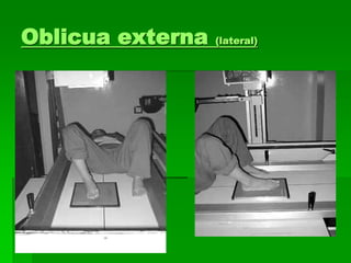 Oblicua externa (lateral)
 