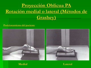 Proyección Oblicua PA
Rotación medial o lateral (Métodos de
Grashey)
Medial Lateral
Posicionamiento del paciente
 