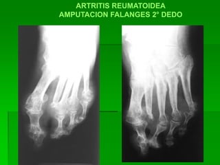 ARTRITIS REUMATOIDEA
AMPUTACION FALANGES 2° DEDO
 