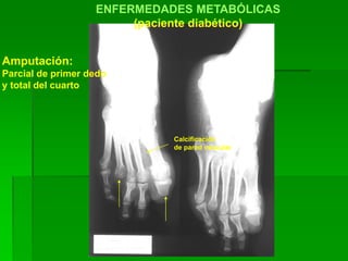 ENFERMEDADES METABÓLICAS
(paciente diabético)
Amputación:
Parcial de primer dedo
y total del cuarto
Calcificación
de pared vascular
 