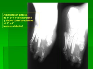 Amputación parcial
de 1° 2° y 4° metatarsiano
y dedos correspondientes
al 1° y 4°
(paciente diabético)
 