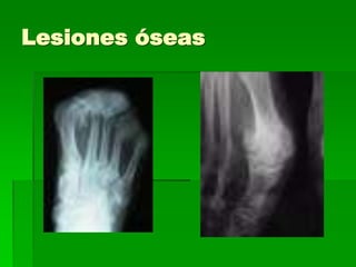 Lesiones óseas
 