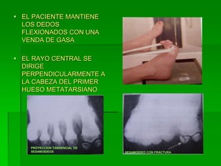  EL PACIENTE MANTIENE
LOS DEDOS
FLEXIONADOS CON UNA
VENDA DE GASA
 EL RAYO CENTRAL SE
DIRIGE
PERPENDICULARMENTE A
LA CABEZA DEL PRIMER
HUESO METATARSIANO
SESAMOIDEO CON FRACTURA
PROYECCION TANGENCIAL DE
SESAMOIDEOS
 