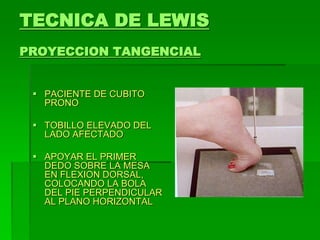 TECNICA DE LEWIS
PROYECCION TANGENCIAL
 PACIENTE DE CUBITO
PRONO
 TOBILLO ELEVADO DEL
LADO AFECTADO
 APOYAR EL PRIMER
DEDO SOBRE LA MESA
EN FLEXION DORSAL,
COLOCANDO LA BOLA
DEL PIE PERPENDICULAR
AL PLANO HORIZONTAL
 