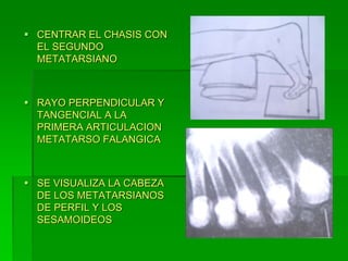  CENTRAR EL CHASIS CON
EL SEGUNDO
METATARSIANO
 RAYO PERPENDICULAR Y
TANGENCIAL A LA
PRIMERA ARTICULACION
METATARSO FALANGICA
 SE VISUALIZA LA CABEZA
DE LOS METATARSIANOS
DE PERFIL Y LOS
SESAMOIDEOS
 