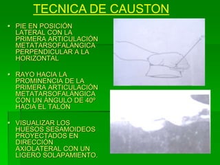  PIE EN POSICIÓN
LATERAL CON LA
PRIMERA ARTICULACIÓN
METATARSOFALÁNGICA
PERPENDICULAR A LA
HORIZONTAL
 RAYO HACIA LA
PROMINENCIA DE LA
PRIMERA ARTICULACIÓN
METATARSOFALÁNGICA
CON UN ÁNGULO DE 40º
HACIA EL TALÓN
 VISUALIZAR LOS
HUESOS SESAMOIDEOS
PROYECTADOS EN
DIRECCIÓN
AXIOLATERAL CON UN
LIGERO SOLAPAMIENTO.
TECNICA DE CAUSTON
 
