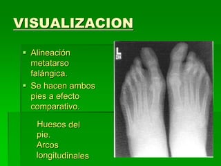 VISUALIZACION
 Alineación
metatarso
falángica.
 Se hacen ambos
pies a efecto
comparativo.
 