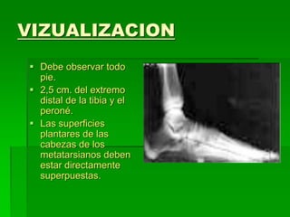 VIZUALIZACION
 Debe observar todo
pie.
 2,5 cm. del extremo
distal de la tibia y el
peroné.
 Las superficies
plantares de las
cabezas de los
metatarsianos deben
estar directamente
superpuestas.
 