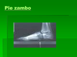 Pie zambo
 
