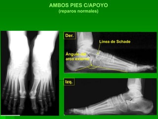 AMBOS PIES C/APOYO
(reparos normales)
Línea de Schade
Ángulo del
arco externo
Der.
Izq.
 
