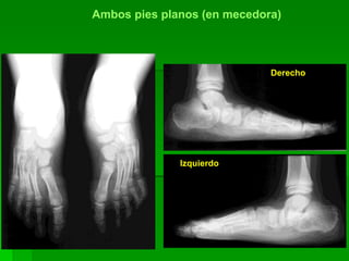 Derecho
Izquierdo
Ambos pies planos (en mecedora)
 