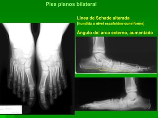 Línea de Schade alterada
(hundida a nivel escafoideo-cuneiforme)
Ángulo del arco externo, aumentado
Pies planos bilateral
 