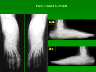 Pies planos bilateral
Der.
Izq.
 