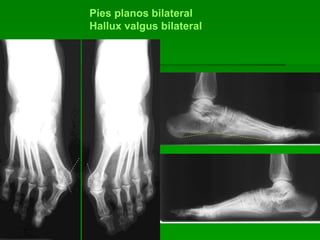 Pies planos bilateral
Hallux valgus bilateral
 
