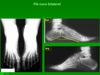 Pié cavo bilateral
Der.
Izq.
 
