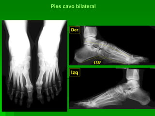 Pies cavo bilateral
Der
Izq
138°
 