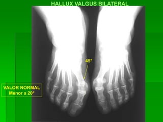 HALLUX VALGUS BILATERAL
45°
VALOR NORMAL
Menor a 20°
 