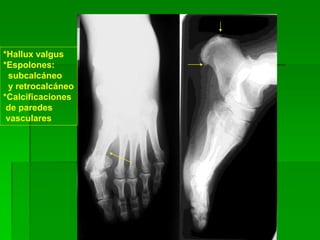 *Hallux valgus
*Espolones:
subcalcáneo
y retrocalcáneo
*Calcificaciones
de paredes
vasculares
 