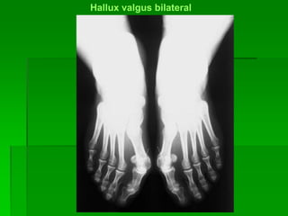 Hallux valgus bilateral
 