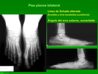 Línea de Schade alterada
(hundida a nivel escafoideo-cuneiforme)
Ángulo del arco externo, aumentado
Pies planos bilateral
 
